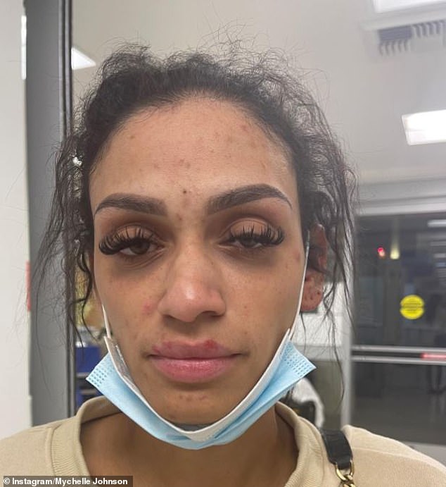 Mychelle Johnson posted photos of injuries all over her body, including her broken nose