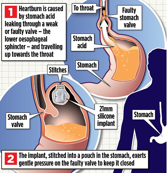 A £12,000 operation could offer hope to thousands of Britons suffering from severe acid reflux problems