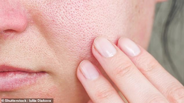 Rosacea is a chronic inflammatory condition that mainly affects the skin and typically causes flushing and redness of the face, pustules and irritation and redness around the eyes (stock image)