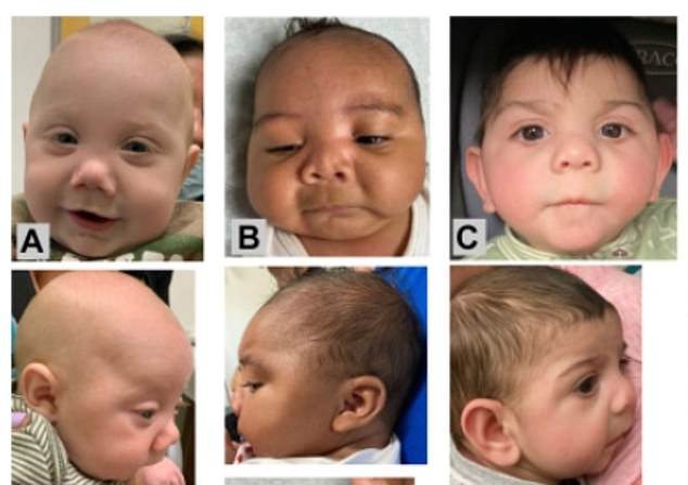 The babies affected by maternal fentanyl use tended to have smaller heads and underdeveloped jawbones