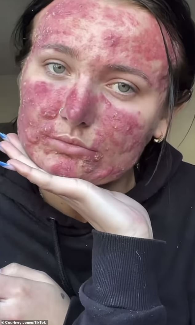 Courtney Jones, from Killamarsh, Sheffield, who was bullied for her severe acne, has become a beauty influencer and skin care expert