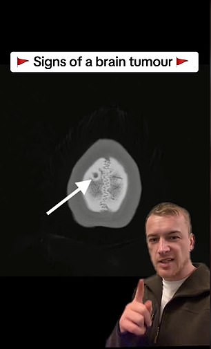 Mr Carpenter showed scans of his brain in 2010 (above), when the tumor was missed, and in 2018, when he was finally diagnosed