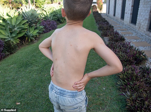 Jennifer took Grayson to hospital after an egg reaction, but doctors were concerned about the spots on his back (pictured).  Jennifer thought they were 'birthmarks', but instead they were café au lait spots - a key indicator of the disease