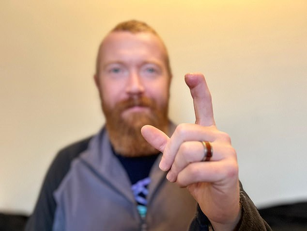 Postman Alasdair Ross, 41, from Bristol, lost his finger after it was destroyed by a dog while making deliveries.  Alasdair, who is also a part-time music teacher, opted for the 'groundbreaking' procedure as it would allow him to continue playing guitar