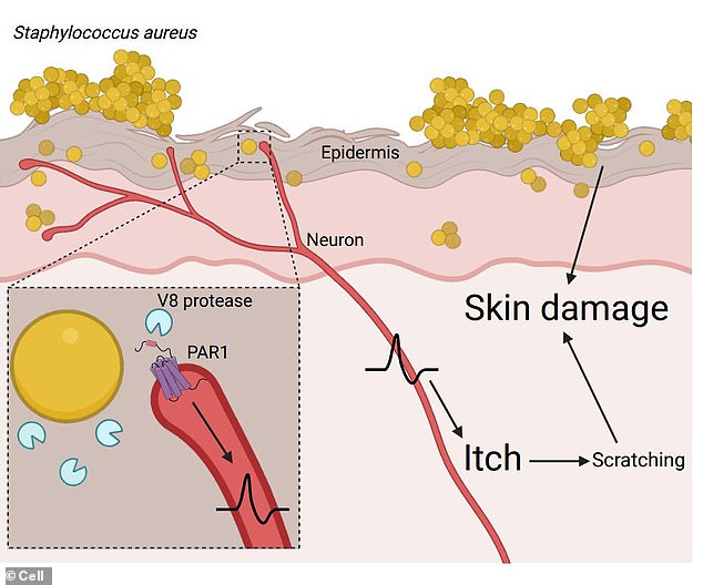 In the study, experts took skin from both arms of 13 people with eczema and 14 'healthy participants'.  They then exposed mice to Staphylococcus aureus, causing them to experience intense itching that worsened over several days and led to skin damage.  The team modified different versions of the staphylococcus aureus microbe to find out which enzymes were responsible for the itch.  Through a process of elimination, they discovered that the enzyme, V8 protease, was responsible