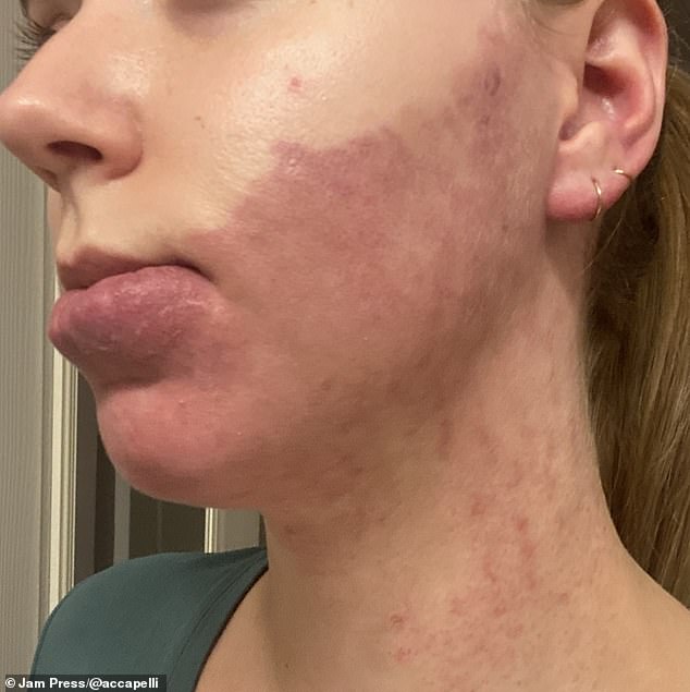 A woman who was born with a large port wine stain birthmark on her face shares how she learned to embrace her unique look - despite getting a lot of stares