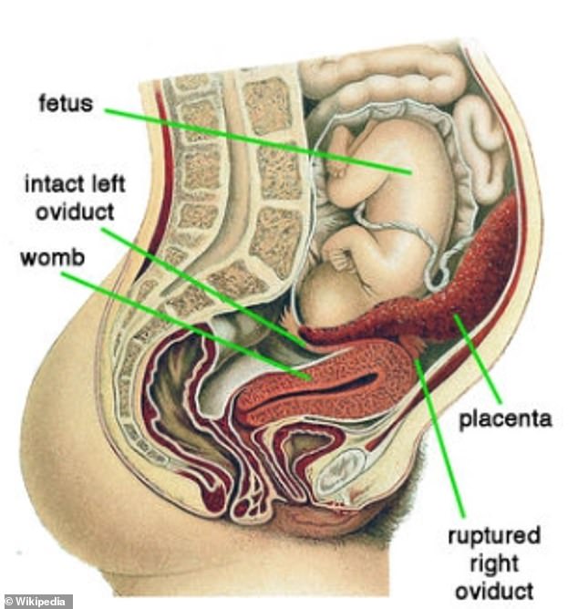 The above shows an abdominal pregnancy,which the woman was diagnosed with.  It reveals the empty uterus as the baby grows in the abdominal cavity instead.  Doctors say this can happen when a baby begins to grow in the fallopian tube, which then ruptures, allowing the fetus to 