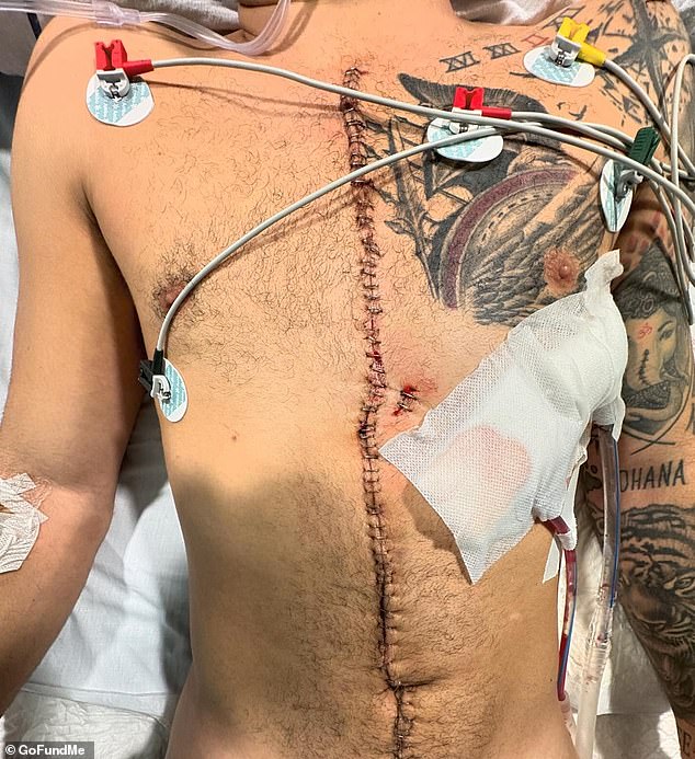 On Tuesday, he shared a confrontational photo to his Instagram showing his new surgical incision from his open-heart surgery, which runs from the top of his chest to the bottom of his navy.