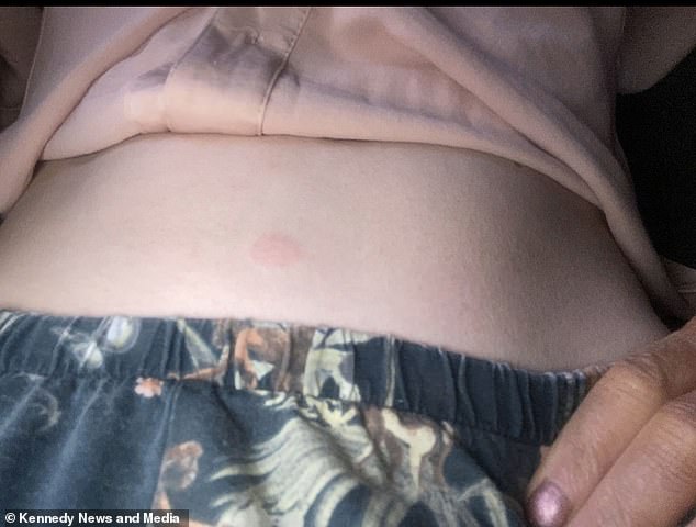 She stabbed herself in the stomach (pictured) before going to work.  However, within seconds her tongue was swollen, her skin itched and her eyes 'began to burn' to the point that she had difficulty opening them.