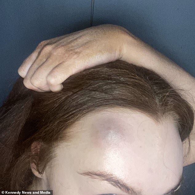 However, the 42-year-old beautician then suffered a severe allergic reaction, causing her tongue to swell and her eyes to burn, causing her to faint and hit her head (pictured)