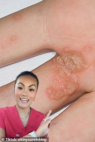 The dermatologist discussed what not to do if you have warts