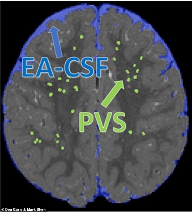 Above is a scan of the brain of a 24-month-old subject showing cerebrospinal fluid (blue) and perivascular space (green) labeled