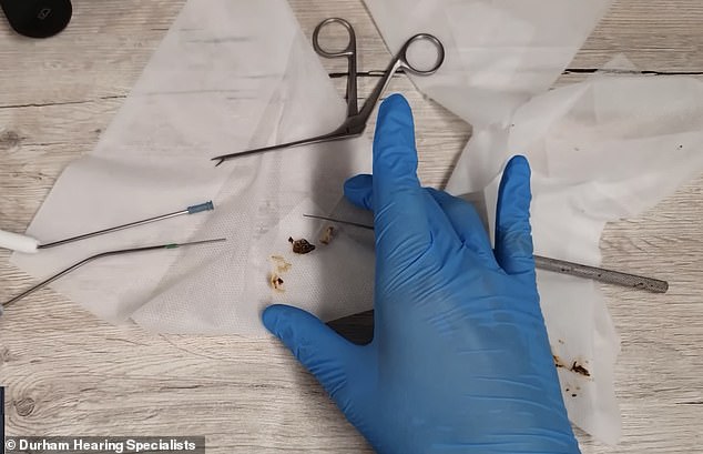 Some of Mr. Conor's tools, as well as some of the earwax obtained from the ear cleaning process