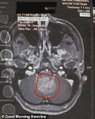 Isabella underwent emergency surgery the day before her 19th birthday to remove a 4cm tumor at the back of her brain