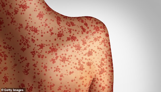 The number of suspected measles cases has doubled in one year