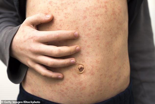 Measles, which usually causes flu-like symptoms and a rash, can cause very serious and even fatal health complications if the disease spreads to the lungs or brain.  One in five children who contract measles will need to go to hospital, and one in fifteen will develop serious complications such as meningitis or sepsis