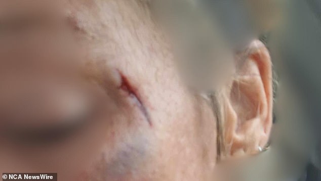 A woman's injuries after she was allegedly attacked by the man, with blood on her face