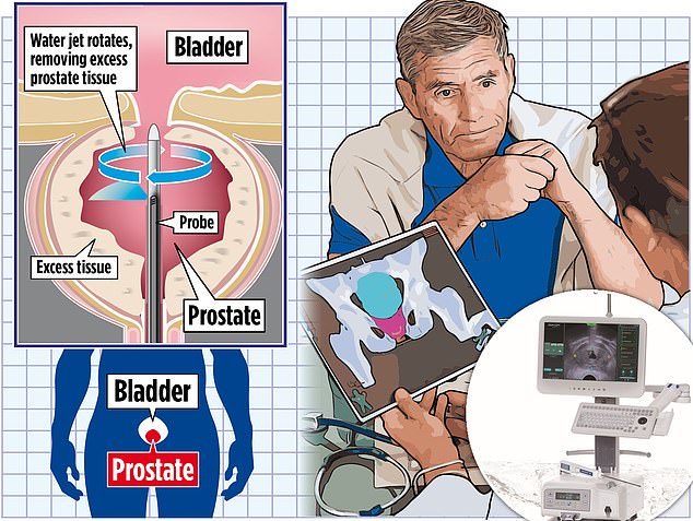 One possible treatment option is a procedure called water ablation.  The National Institute for Health and Care Excellence (NICE) recently recommended that doctors in England offer this as a first-line treatment for enlarged prostate, although the NHS warns that availability is limited because many surgeons have not yet been trained in the technique.