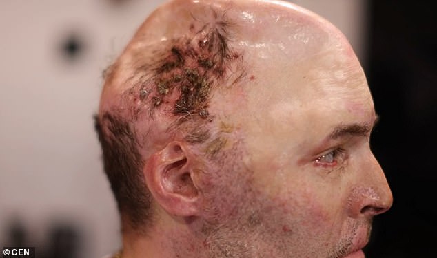 Grim photos of his injuries show how surgeons had to remove a huge chunk of his skull in 2017 to protect his massively swollen brain