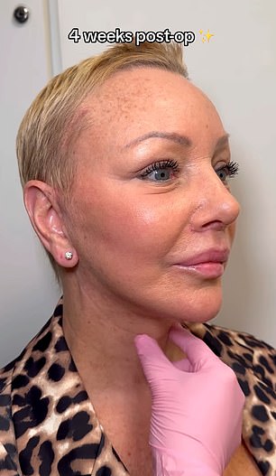 The internet is in awe of a 60-year-old woman's staggering before-and-after transformation after a facelift.  In the photo: afterwards