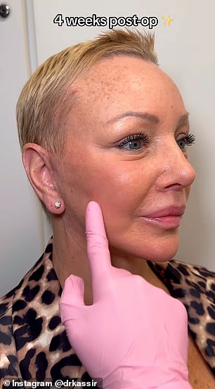 The plastic surgeon performed a full facial rejuvenation on the unnamed woman, who was left with a youthful glow just four weeks after the surgery.  In the photo: afterwards