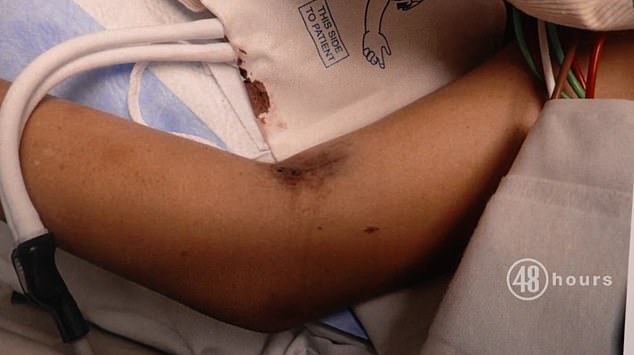 Mandadi was described as covered in bruises and scratches from head to toe.  The victim's arm is pictured here while she was in the hospital before her death