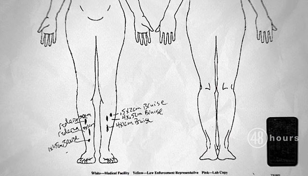 A diagram shows the numerous injuries to Cayley Mandadi's face and body