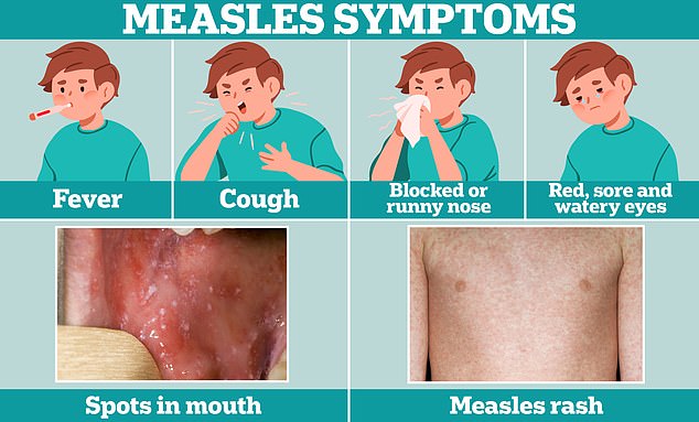 Cold symptoms, such as fever, coughing and a runny or stuffy nose, are usually the first sign of measles.  A few days later, some people develop small white spots on the inside of their cheeks and the back of their lips.  The characteristic rash of measles also develops, usually starting on the face and behind the ears, before spreading to the rest of the body.