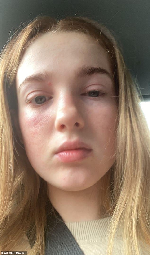Within a few days, Amelia had developed a bacterial infection in the tissues under the skin – a condition known as cellulitis – and the infection had traveled to her eye.