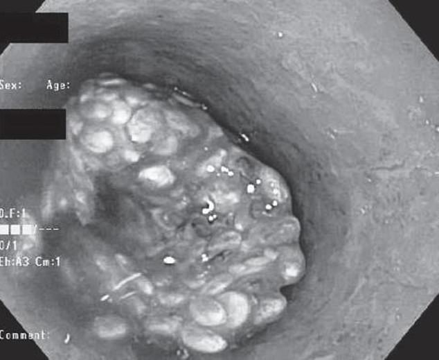 A 2014 case report detailed how a man swallowed a tablespoon of chia seeds with water and had them inserted into his digestive tract