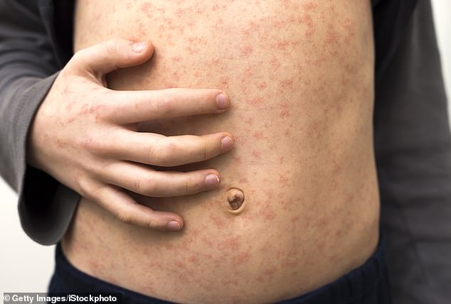 Measles looks a lot like less serious skin rashes, so it can be mistaken for something not worth worrying too much about