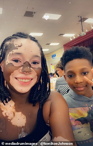 “If all my pigmentation came back it wouldn't bother me, but I've lived with vitiligo for over 20 years and it would be confusing for my family,” Ms Johnson said.