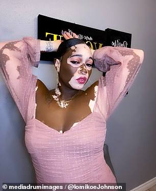 It's unclear whether Ms. Johnson's skin will be closer to the skin it was before her vitiligo diagnosis, but she has said she will be comfortable in her own skin regardless.