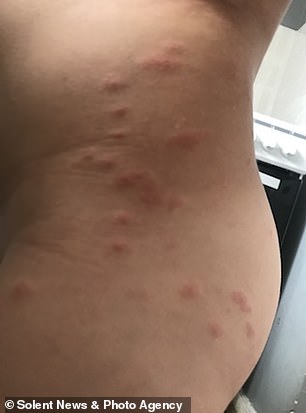 Above, a single mother in Britain last November resorted to sleeping in her bath due to a bedbug infestation that left her and her children bloodied and scarred