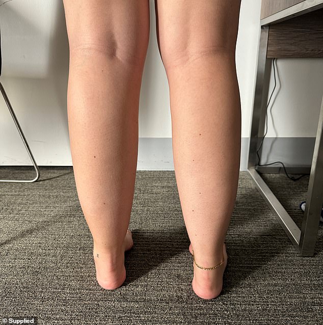 In the photo Lois's legs: Blood clots are not always visible from the surface, so it is essential to consult a doctor if symptoms persist.  The risk of blood clots is greater after flying due to the long periods of immobility and reduced air pressure