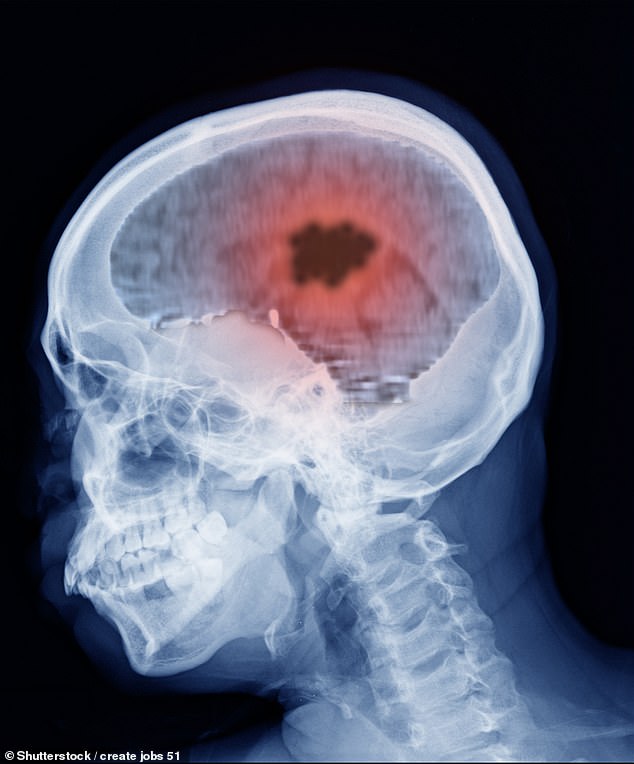 Experts say it could speed diagnosis and treatment while reducing the need for invasive and risky surgeries used to diagnose most brain tumors (Stock Image)