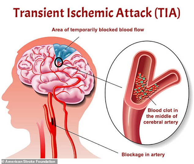 A mini-stroke, medically known as a transient ischemic attack, occurs when a blockage occurs in a person's cerebral artery, preventing blood supply to the brain.  It has the same symptoms as a regular stroke, but resolves on its own within 24 hours