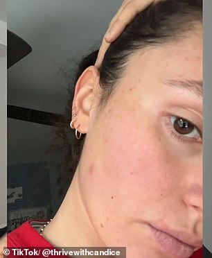 Candice also shared photos showing red pimples along her jawline before she started dry brushing (pictured), and photos afterward showing her skin looking brighter