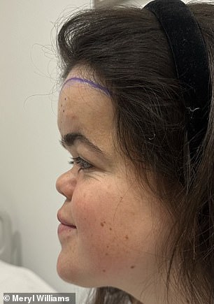 The procedure involved removing the top part of her forehead and then lifting her scalp and moving it forward.