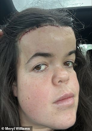 Despite the bloody procedure, the brunette beauty revealed she was glad she had it done, but admitted she wouldn't want to do it again