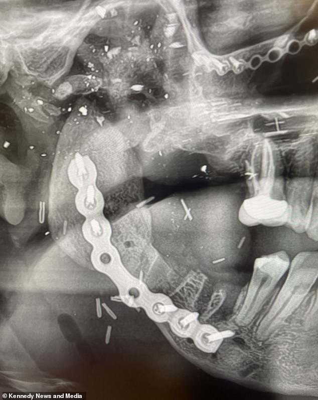 Joshua remained conscious and managed to crawl across the carpet and knock on the bedroom wall to alert his brother Anthony, 32.  Image of Joshua's jaw.