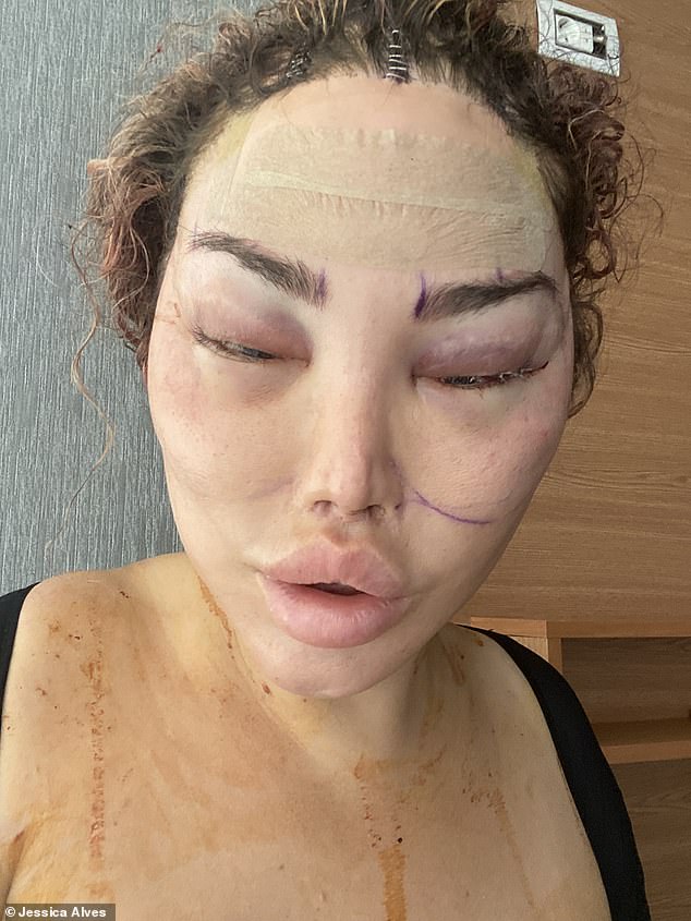 She hopes the latest operation will help hide her scar and give her a boost of confidence after being traumatized by a horrific kidnapping in her native Brazil (pictured after a previous operation)