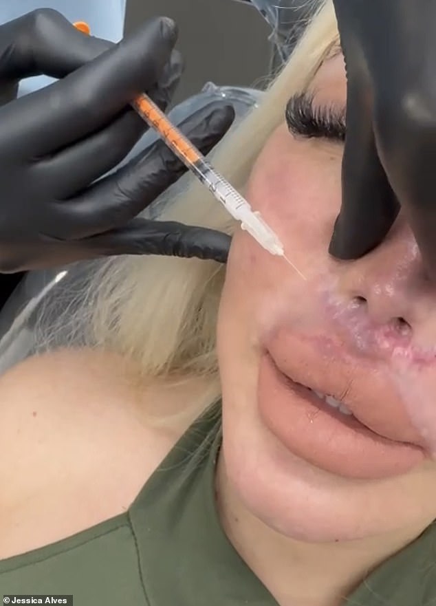 Jessica explained: 'Seven months ago I had a lip lift which left me with a horrible scar that I have to cover with make-up and try to reduce with injections'