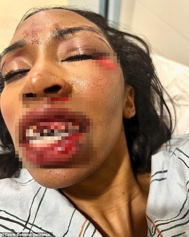 Teeth were chipped and knocked out of her jaw when her face was injured when the food cart hit her