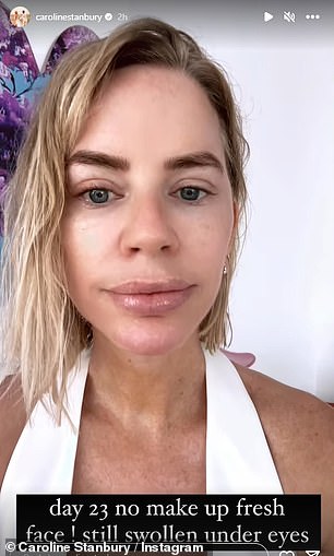 Three weeks after the facelift, Caroline shared a makeup-free video with Instagram followers, admitting that the scars were almost gone