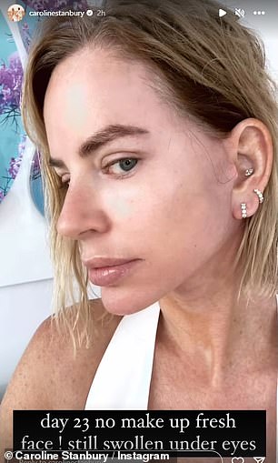 The Real Housewives Of Dubai star shared another update on her latest cosmetic procedure after hosting a short Q&A