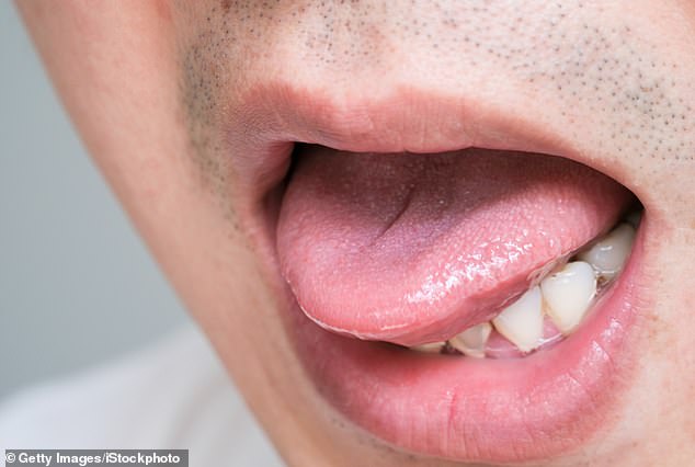 Within weeks of infection, syphilis can cause sores in the mouth or around the genital area.  These are contagious and can transmit the disease