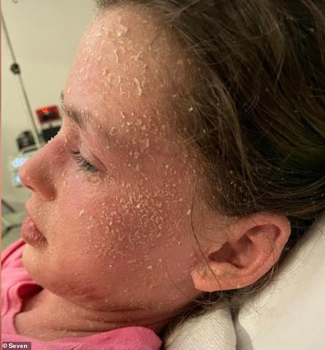 A young girl diagnosed with extreme eczema, Summah Williams, has also been dealt a devastating blow after being told she is allergic to her own tears and sweat (pictured)