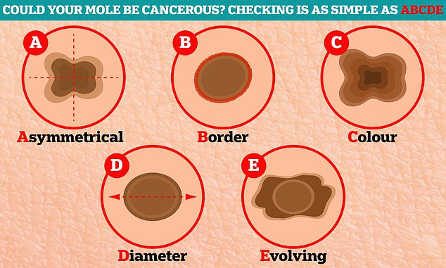 Could YOUR birthmark be cancer Checking is as easy as