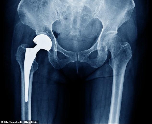 Today's reader has DR.  ELLIE CANNON asked about the side effects they experience after hip replacement surgery